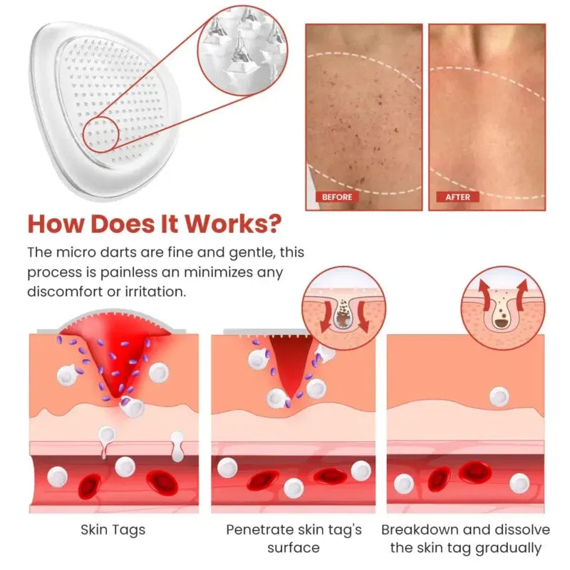Derma Smooth Skin Tag Removal Patch🌟