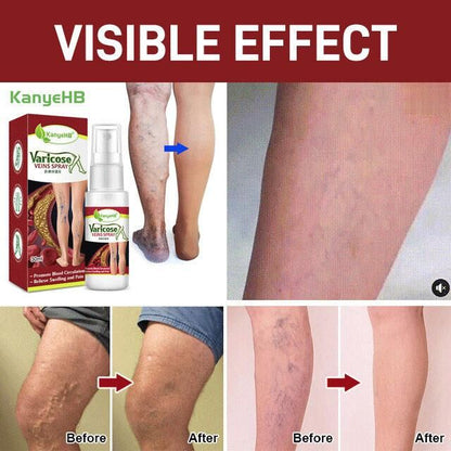 Vein Healing Varicose Veins Treatment Spray - Buy 1 Get 1 Free 🔥