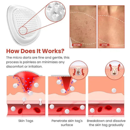 Derma Smooth Skin Tag Removal Patch🌟