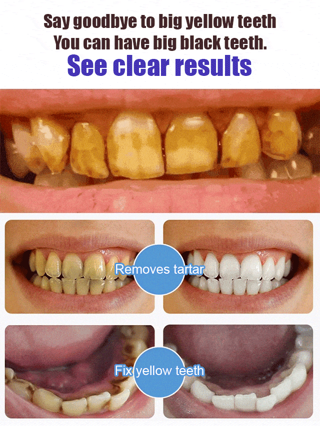 Intensive Teeth Whitening Toothpaste - Rated (⭐️⭐️⭐️⭐️⭐️ 4.8/5 By 2 Lakh+ ✅ Happy Customers)